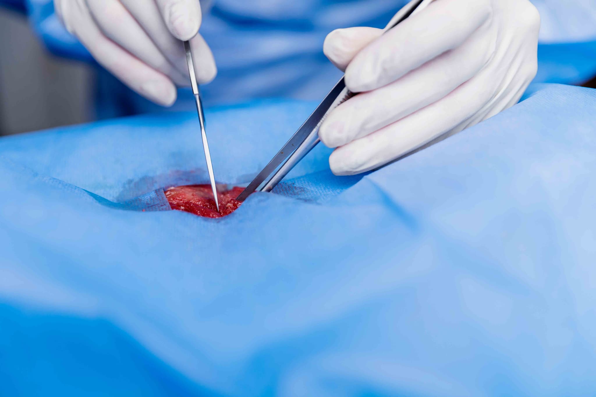 Endometrial Ablation treatment