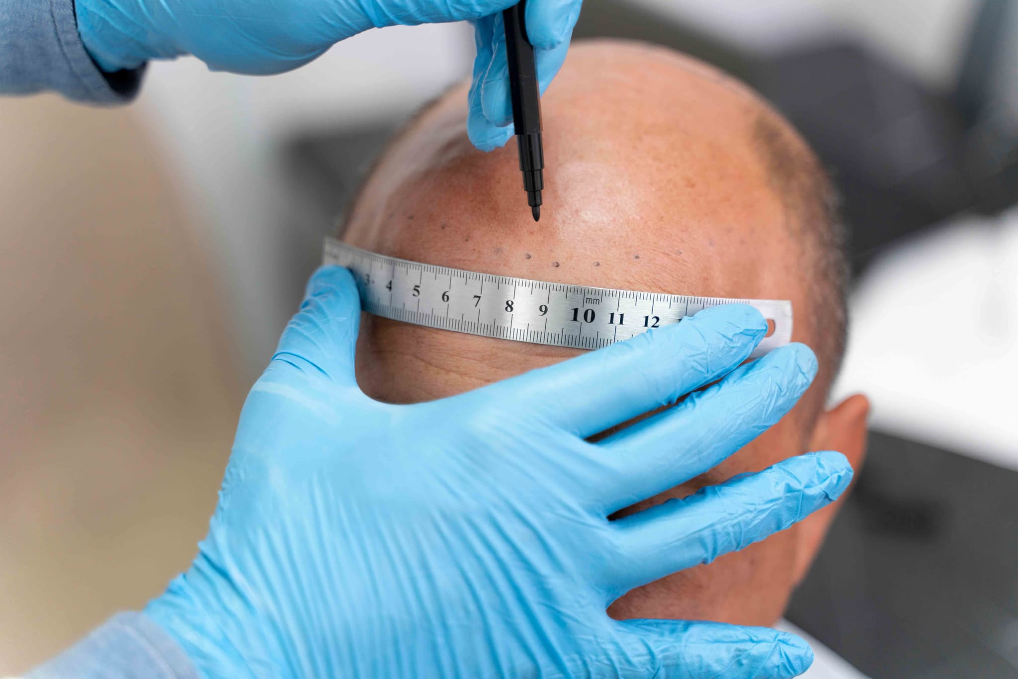 Scalp Micropigmentation treatment