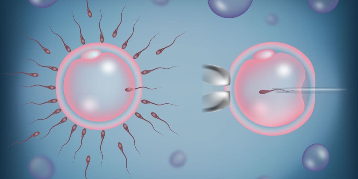 IVF with Intracytoplasmic Sperm Injection (ICSI) treatment