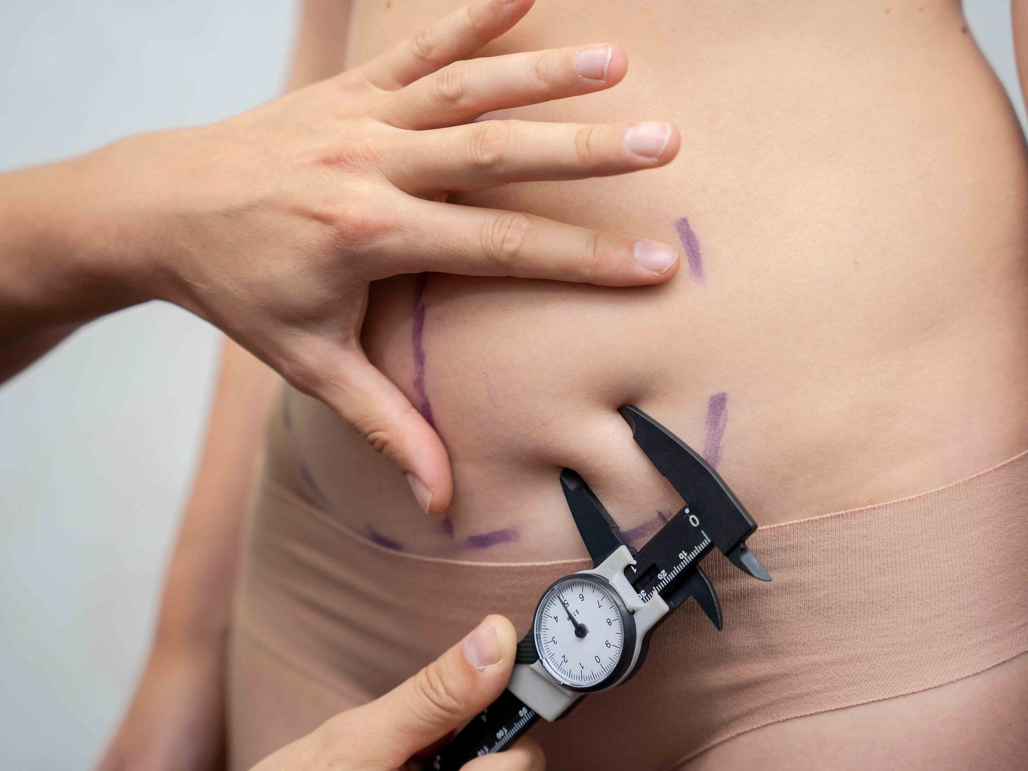 Abdominoplasty (Tummy Tuck) treatment