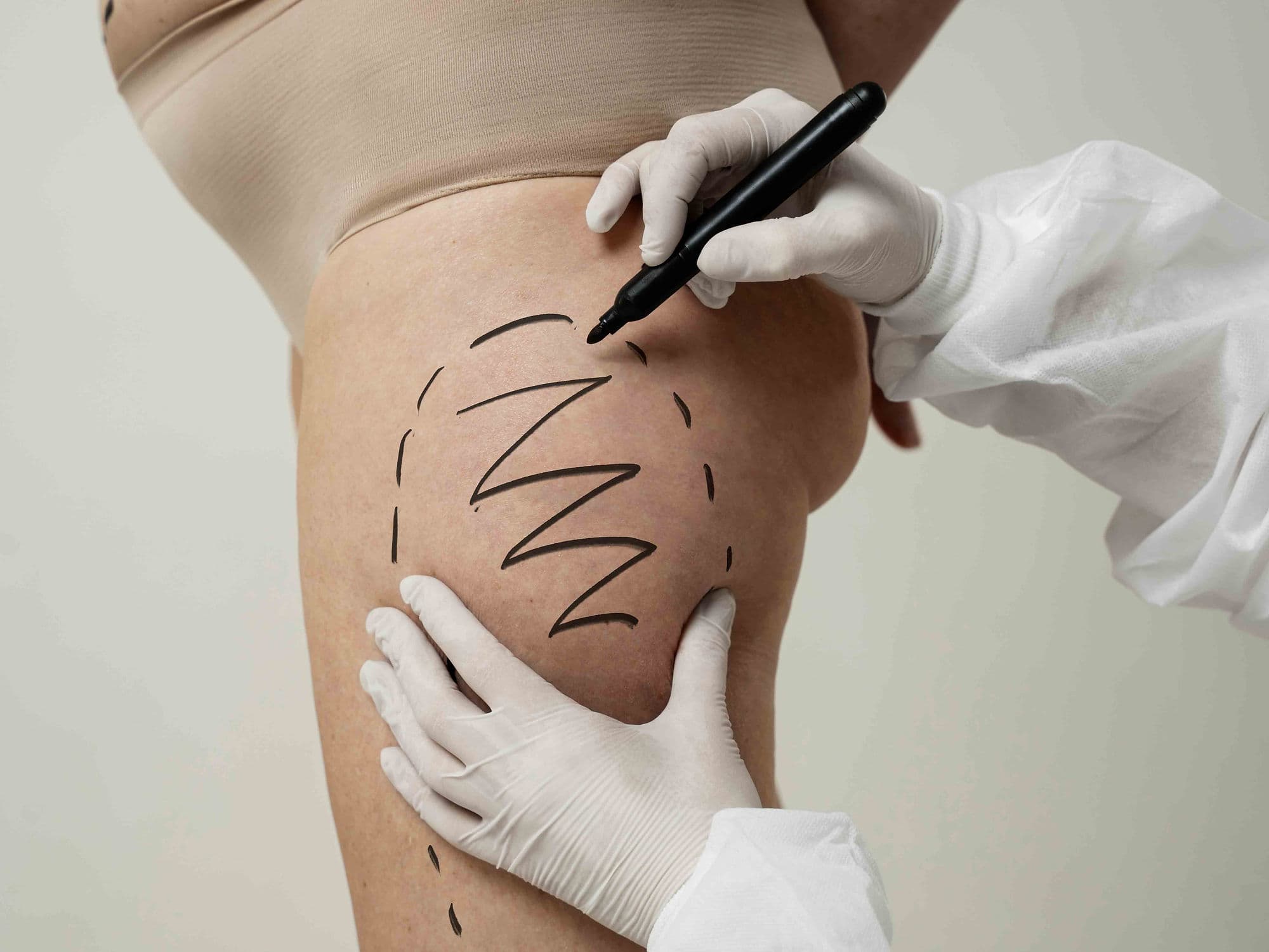 Thigh Lift Surgery treatment