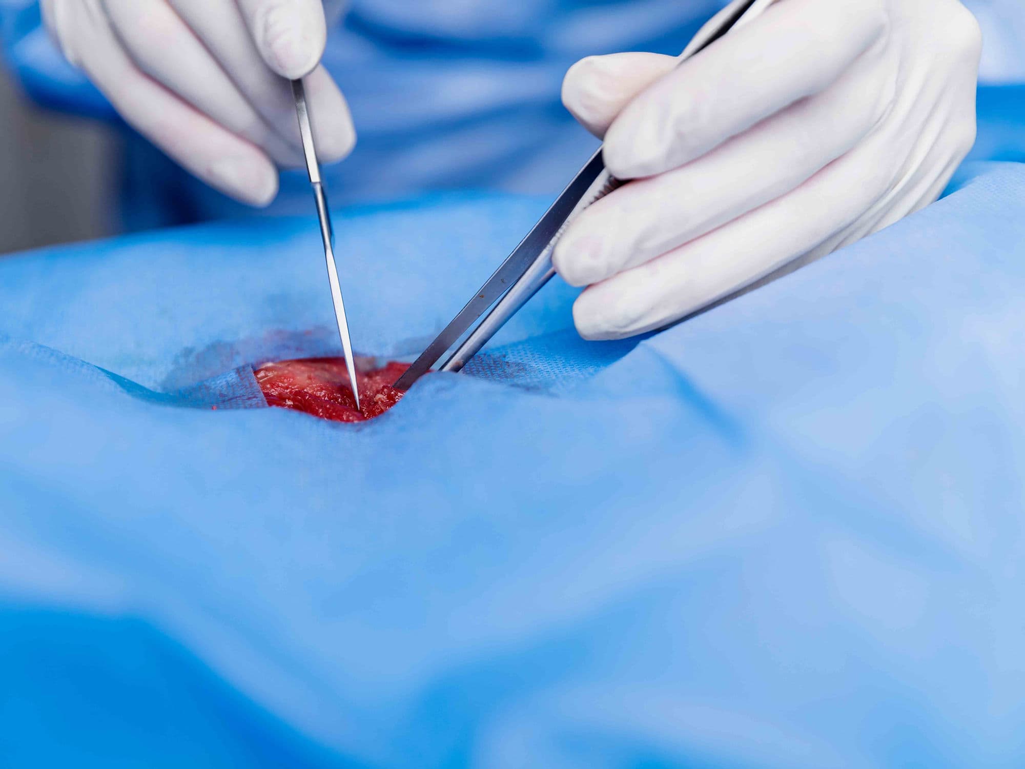 Endometrial Ablation treatment