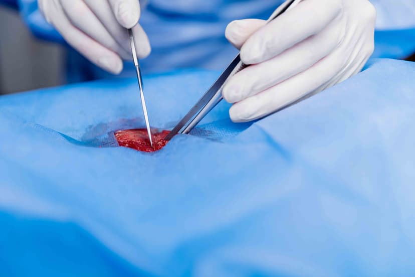 Endometrial Ablation