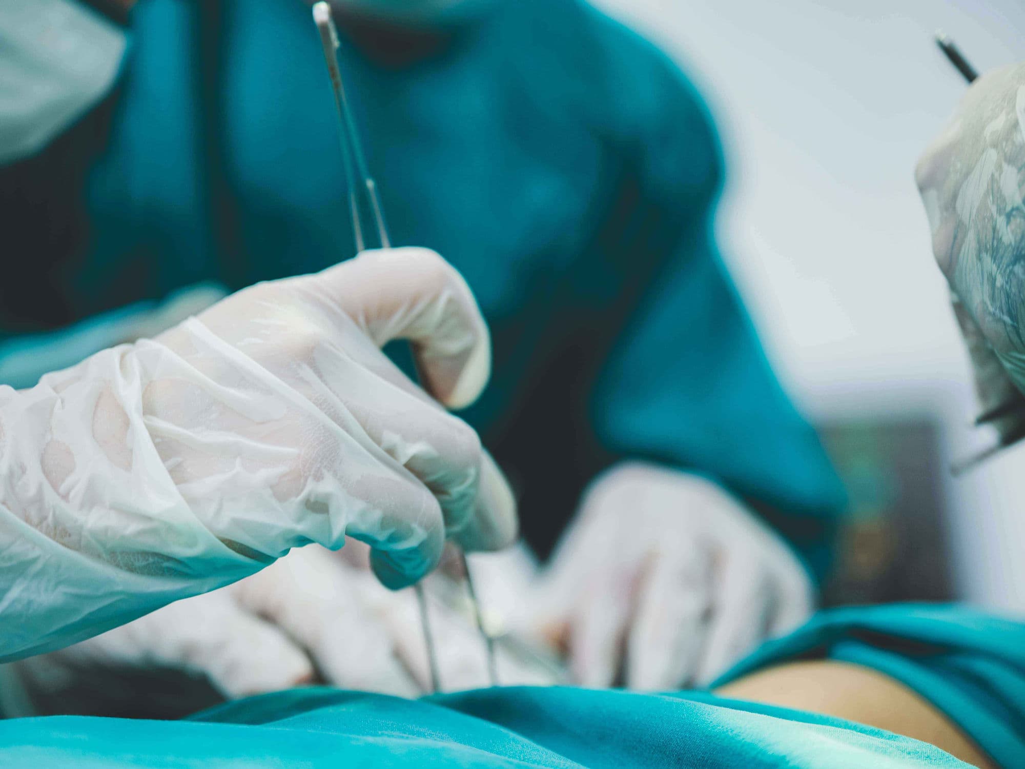IVC Filter Placement treatment