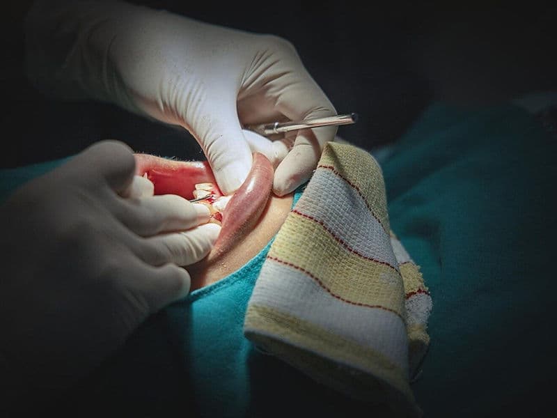 Polypectomy (Uterine Polyp Removal)
