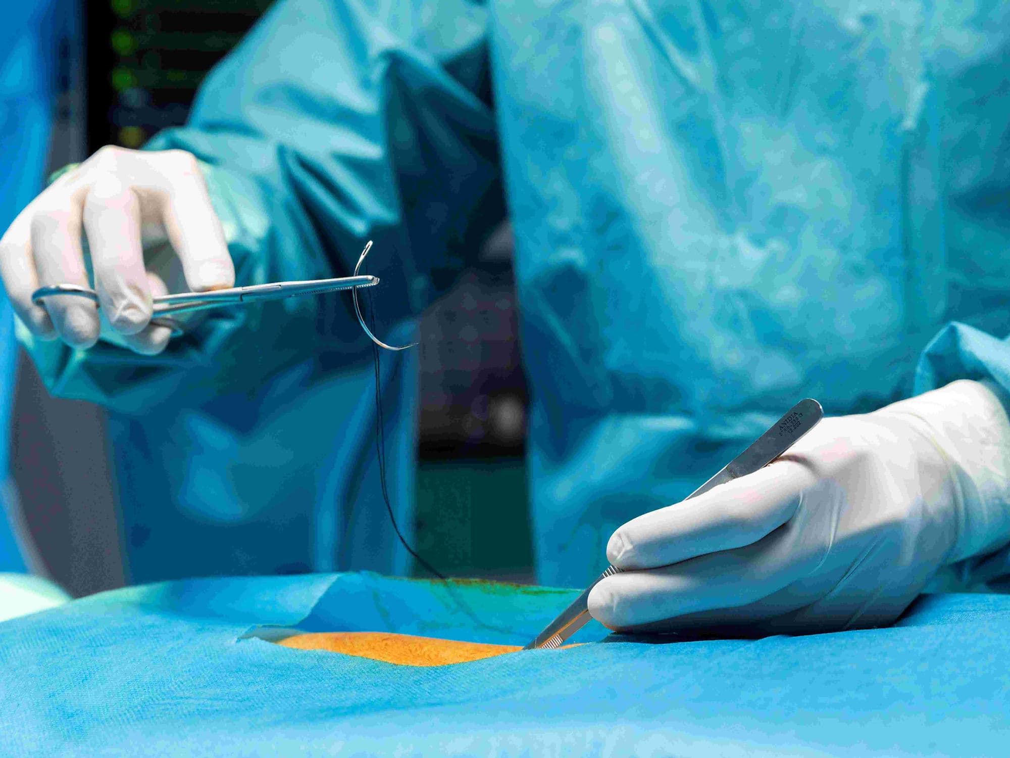 Incisional Hernia Repair treatment