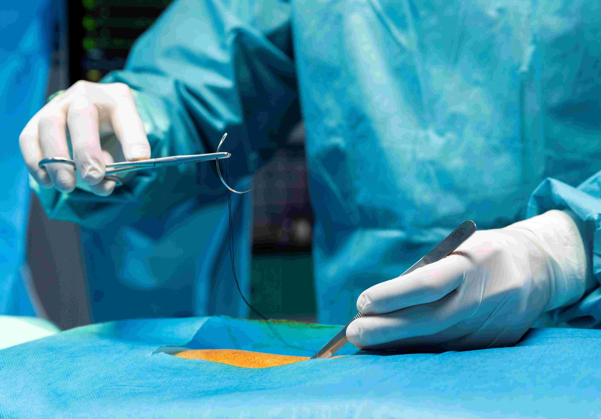 Incisional Hernia Repair hospital
