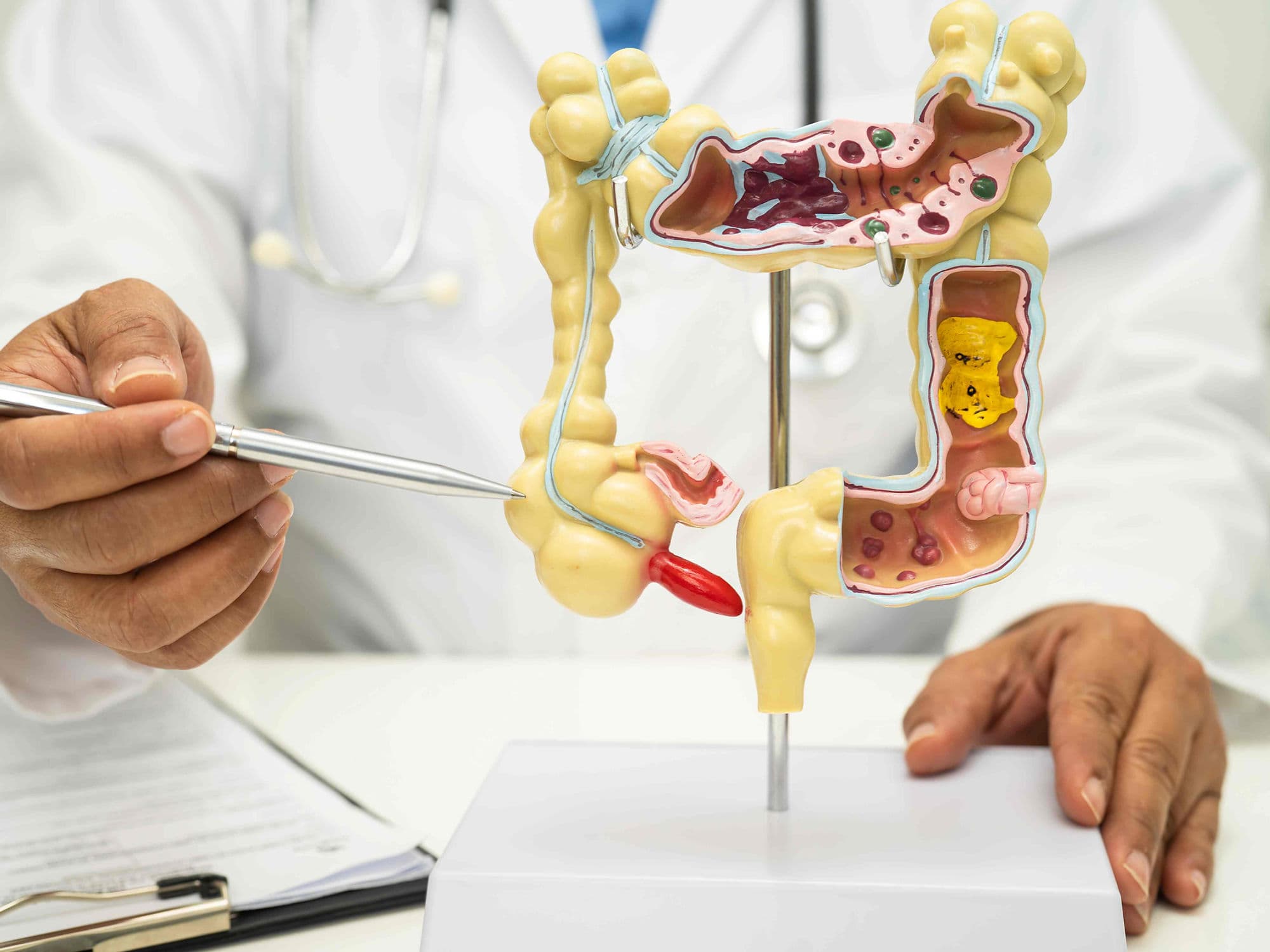 Colectomy (Colon Cancer) treatment