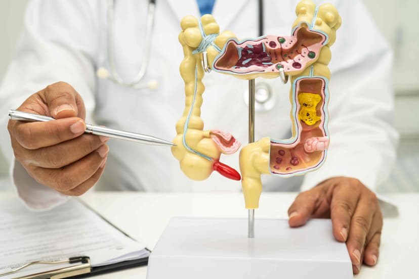 Colectomy (Colon Cancer)