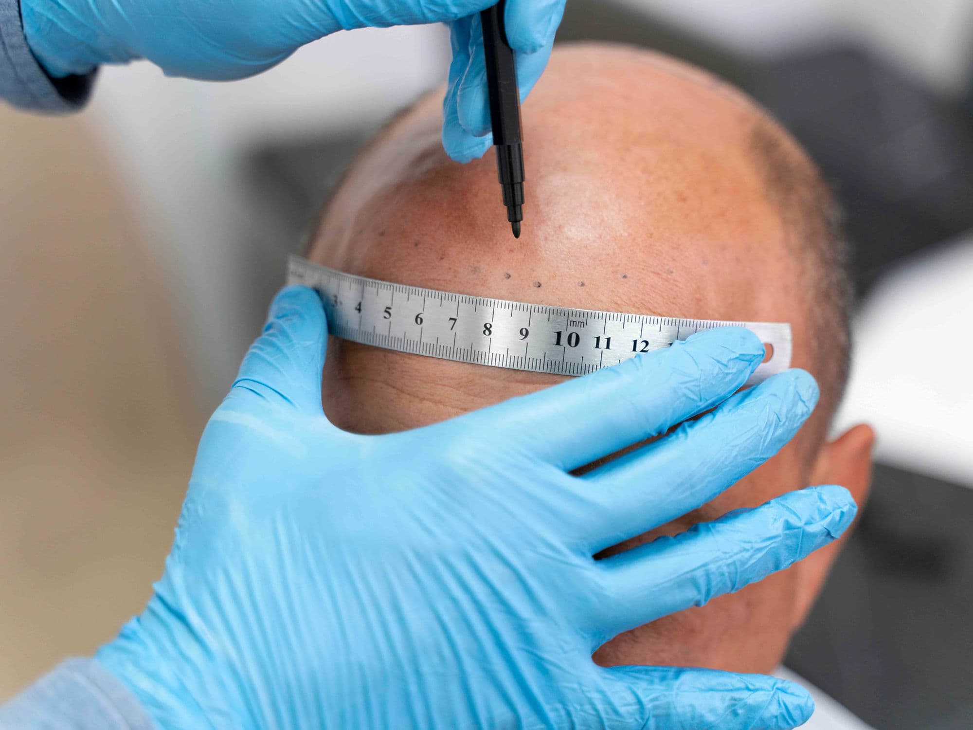 Scalp Micropigmentation treatment