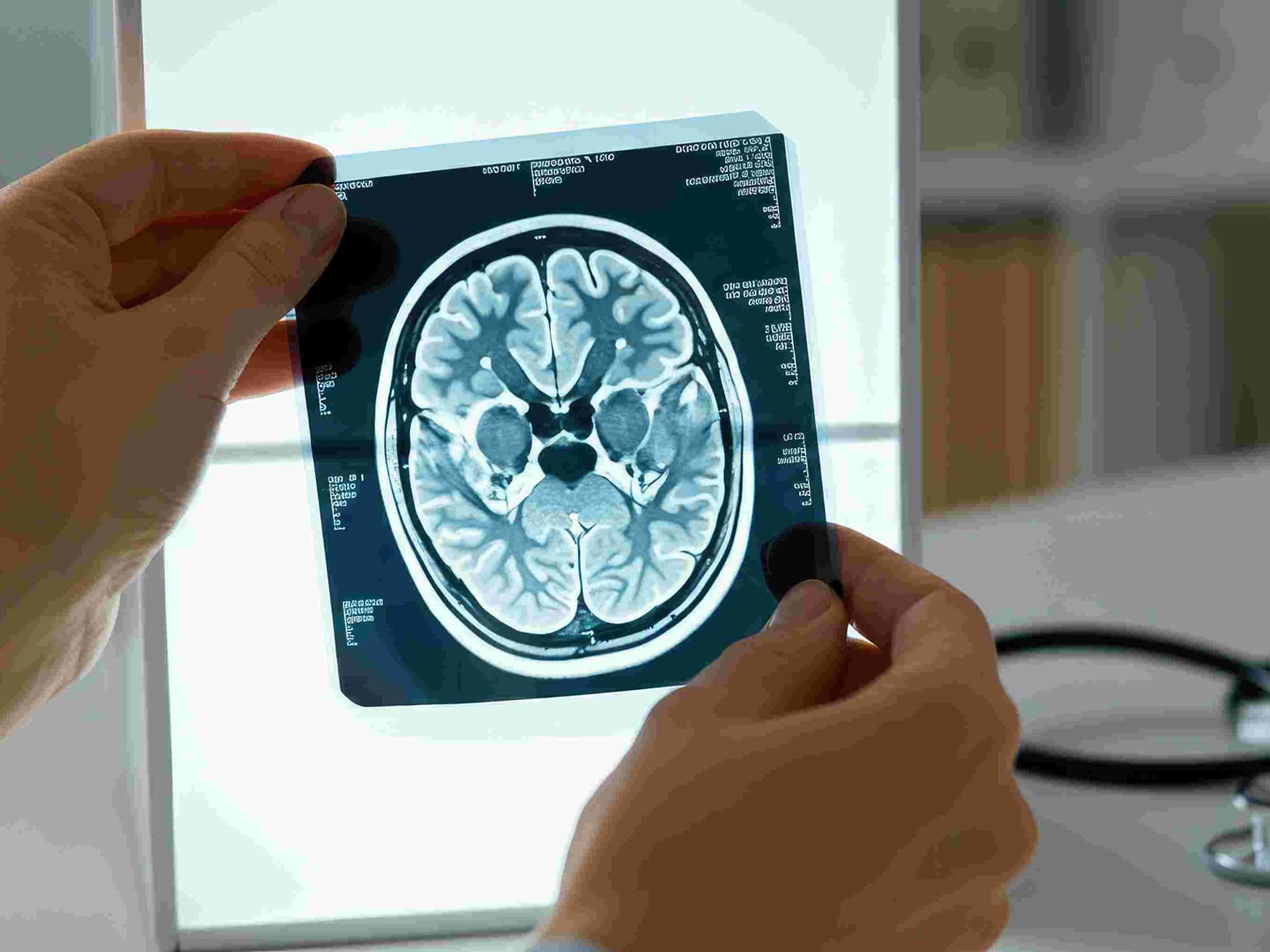 Aneurysm Clipping treatment