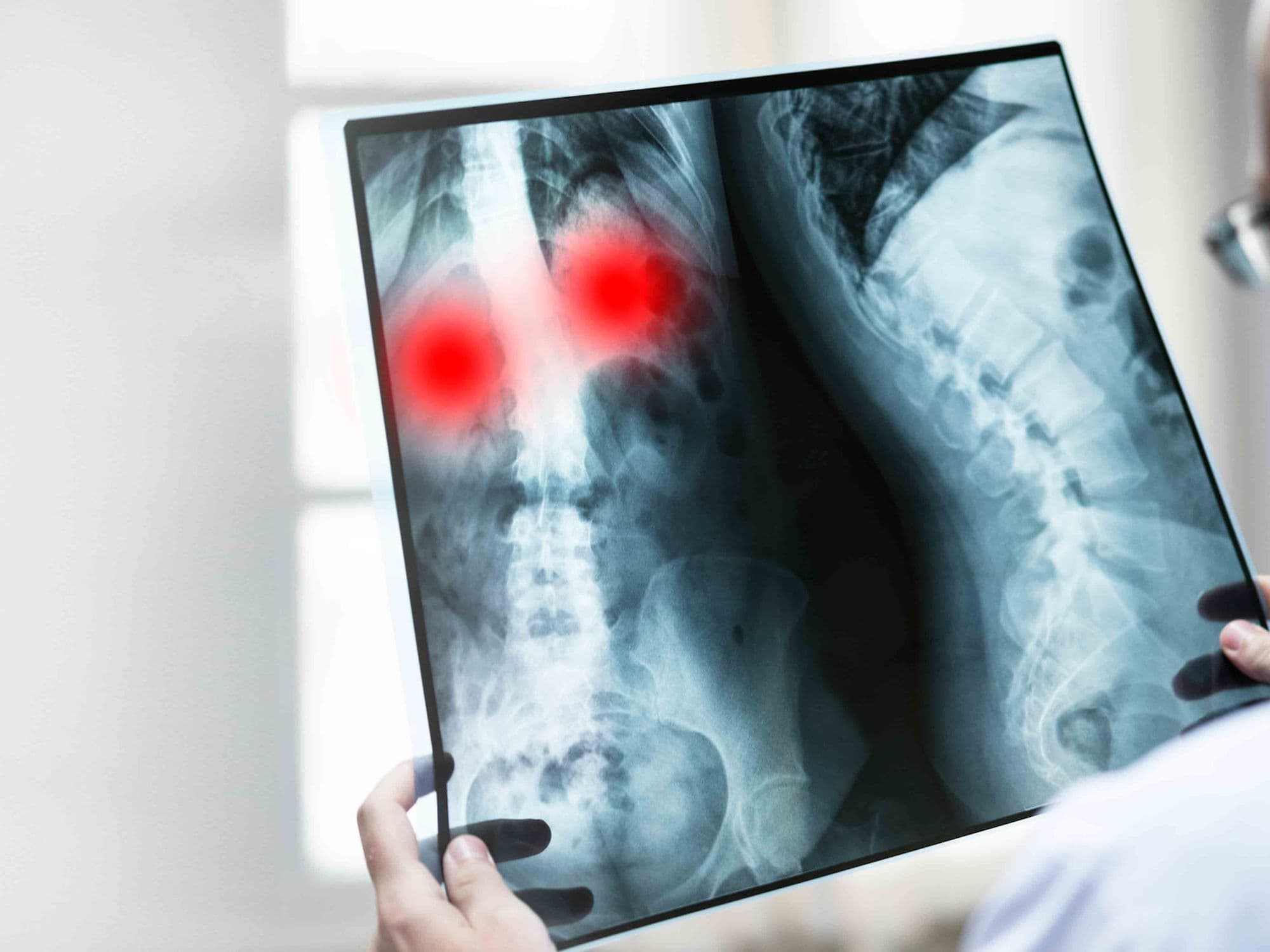 Spinal Tumor Removal treatment