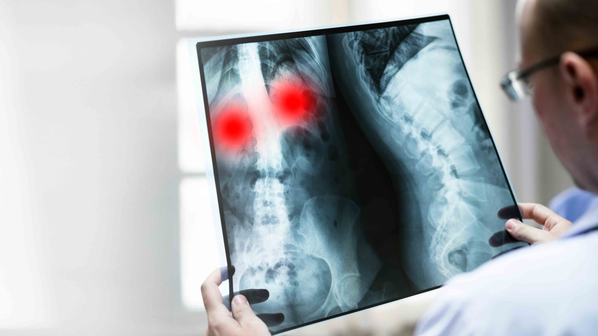 Spinal Tumor Removal hospital